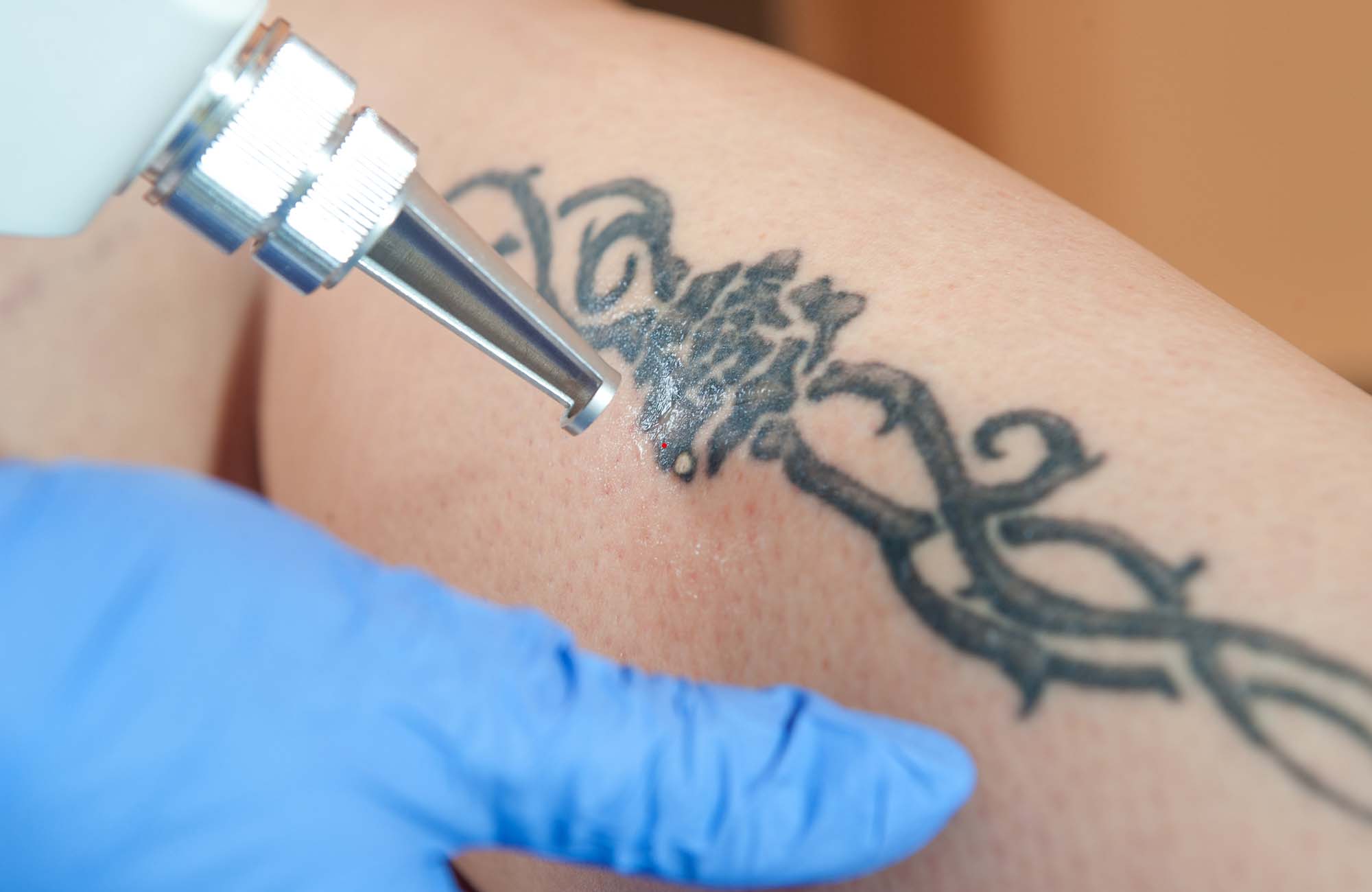 Tattoo removal of leg tattoo