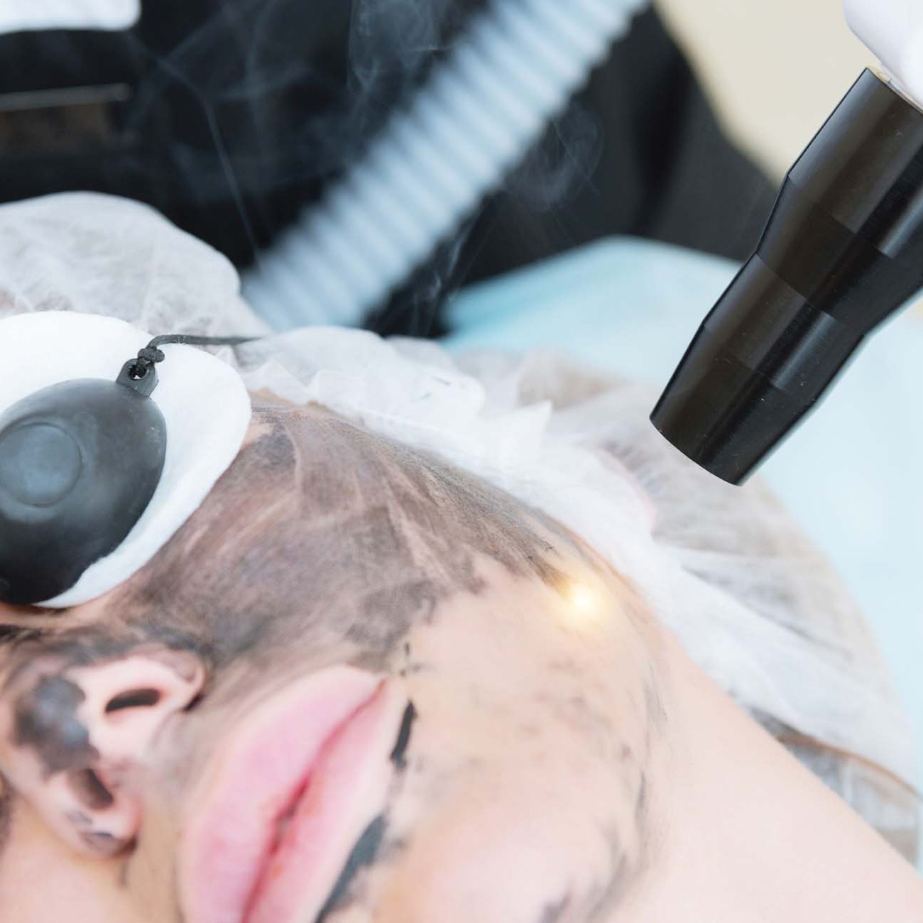 Woman getting a carbon laser facial